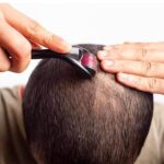 RadBizz Derma Roller and Storage Case - 0.25mm